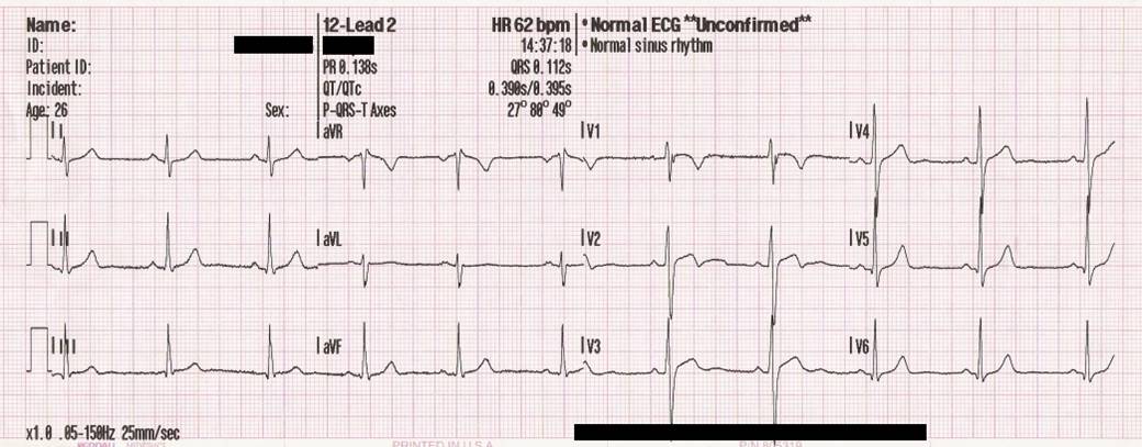 12-lead ECG result